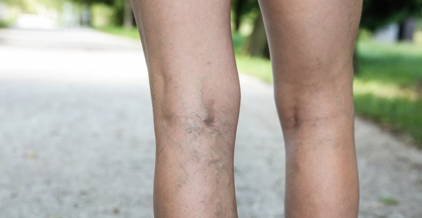 A woman with deep vein thrombosis