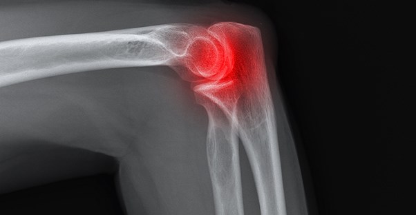 an injured elbow