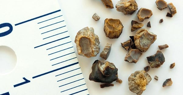 Understanding Kidney Stone Types