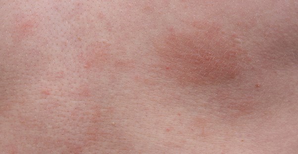 dermatitis on skin