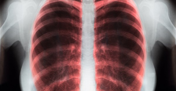 an x-ray of a lung shows how COPD treatment is working