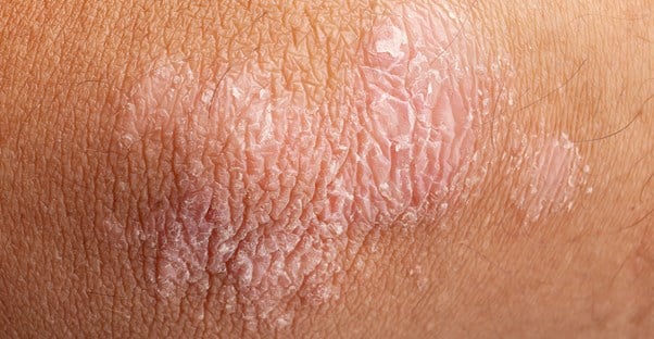 an area of psoriasis is shown on the elbow of an individual