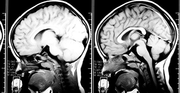 Brain scan. Causes of traumatic brain injury.