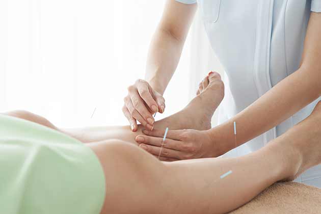 Acupuncture