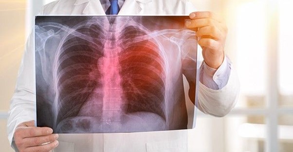 10 Signs and Symptoms of Pneumonia main image