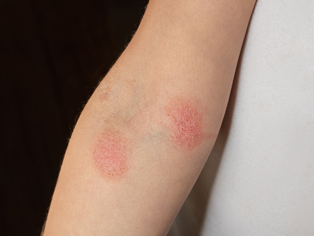 Lymphoma