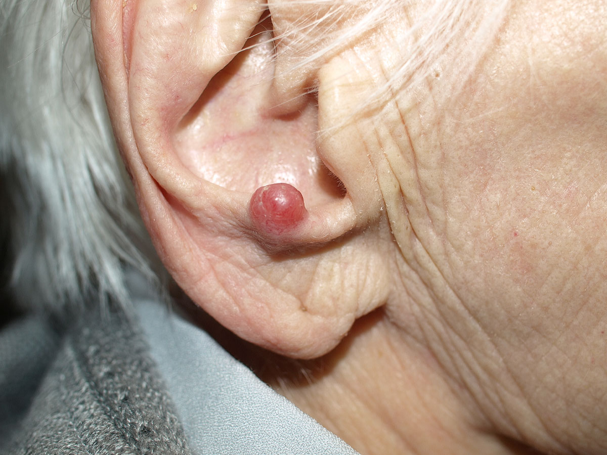 Melanoma