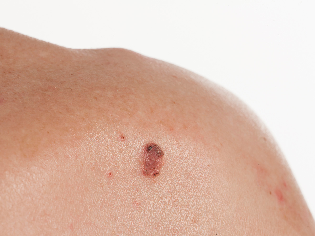 Squamous Cell Carcinoma (SCC)