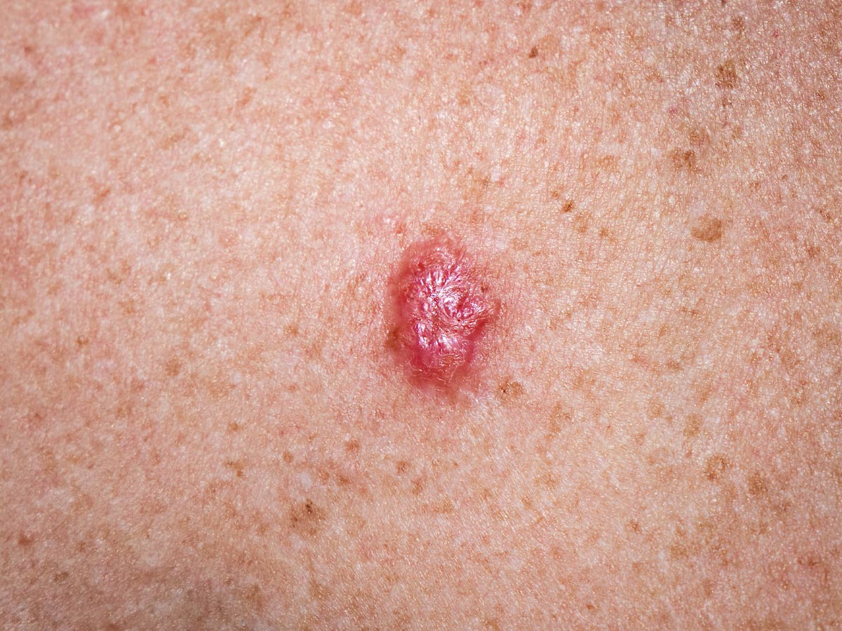 Basal Cell Carcinoma (BCC)