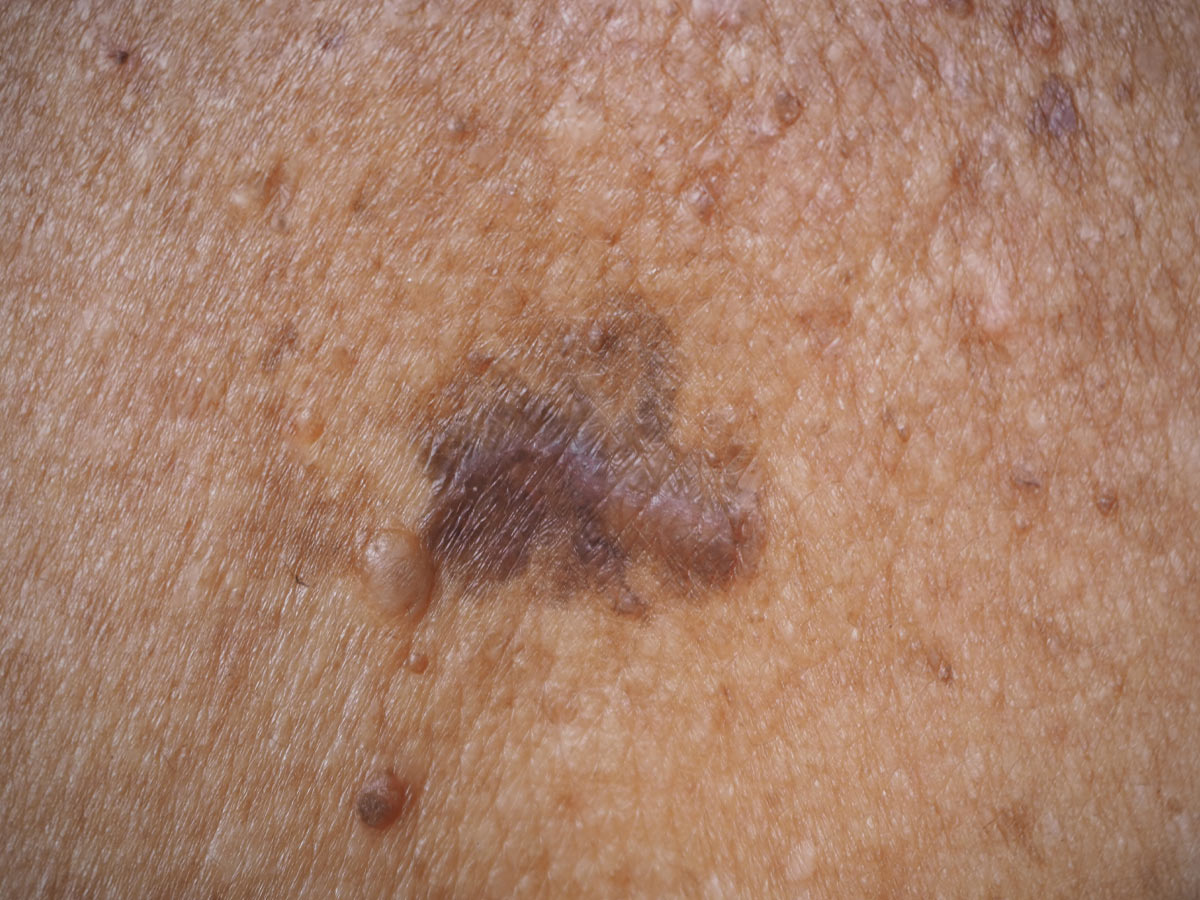 Merkel Cell Carcinoma