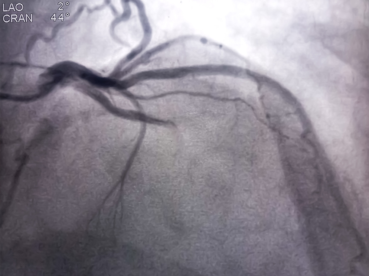 Damage to Blood Vessels