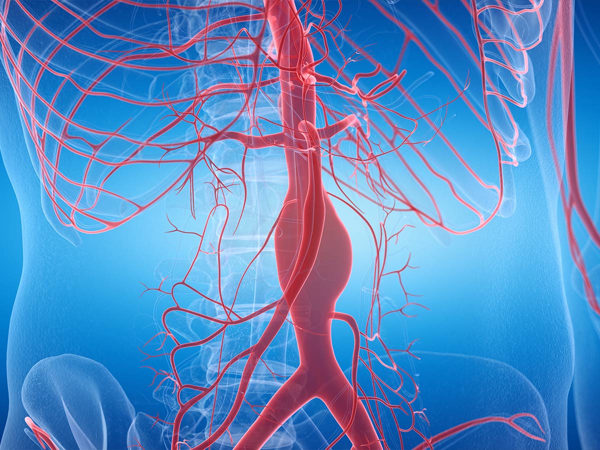 Aortic Aneurysm