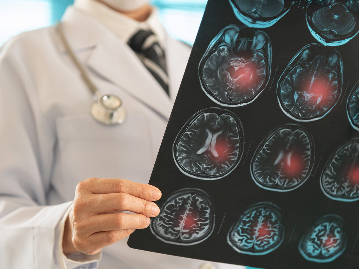 Aneurysms in Other Arteries