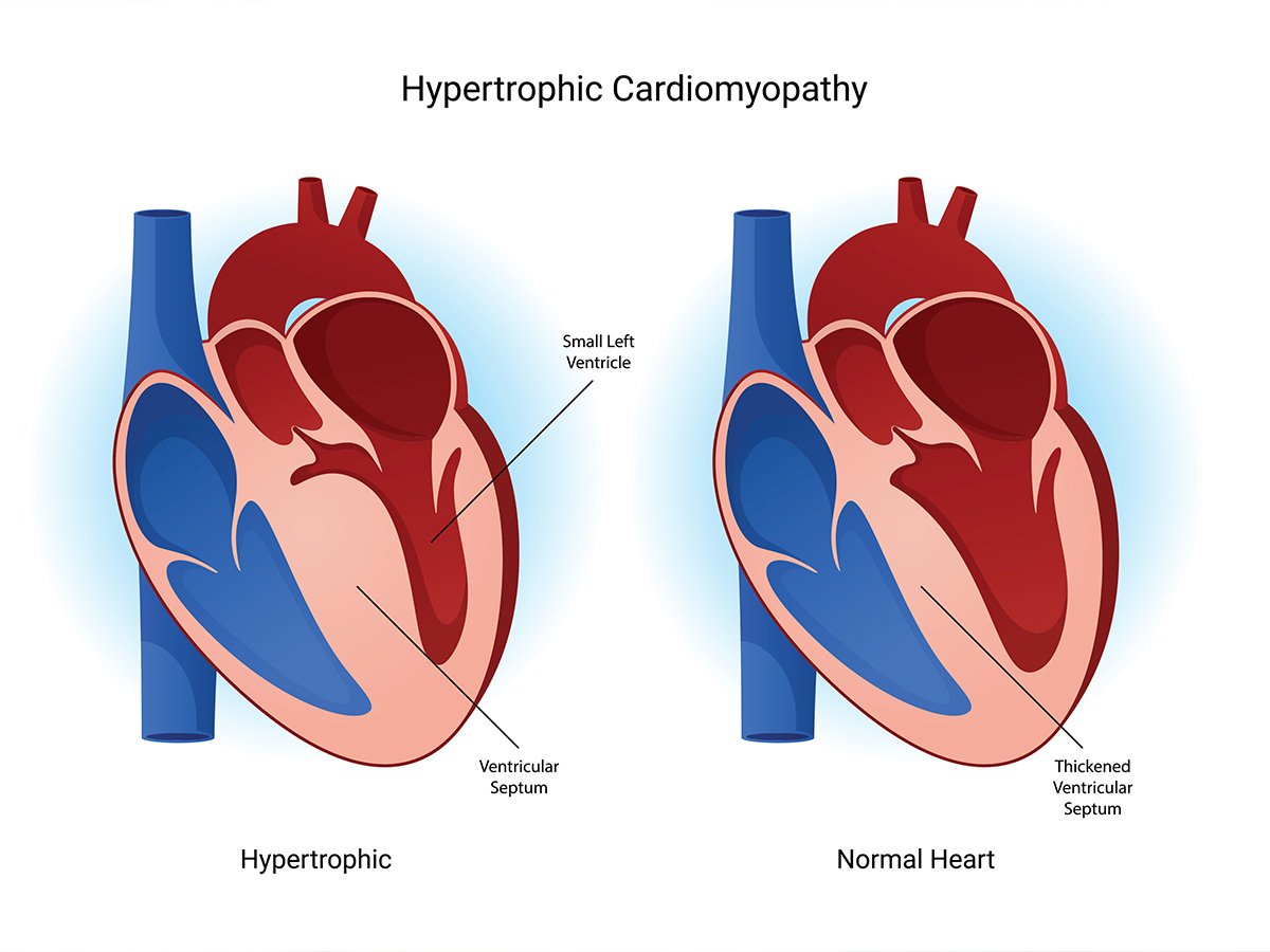 Left Ventricular Hypertrophy