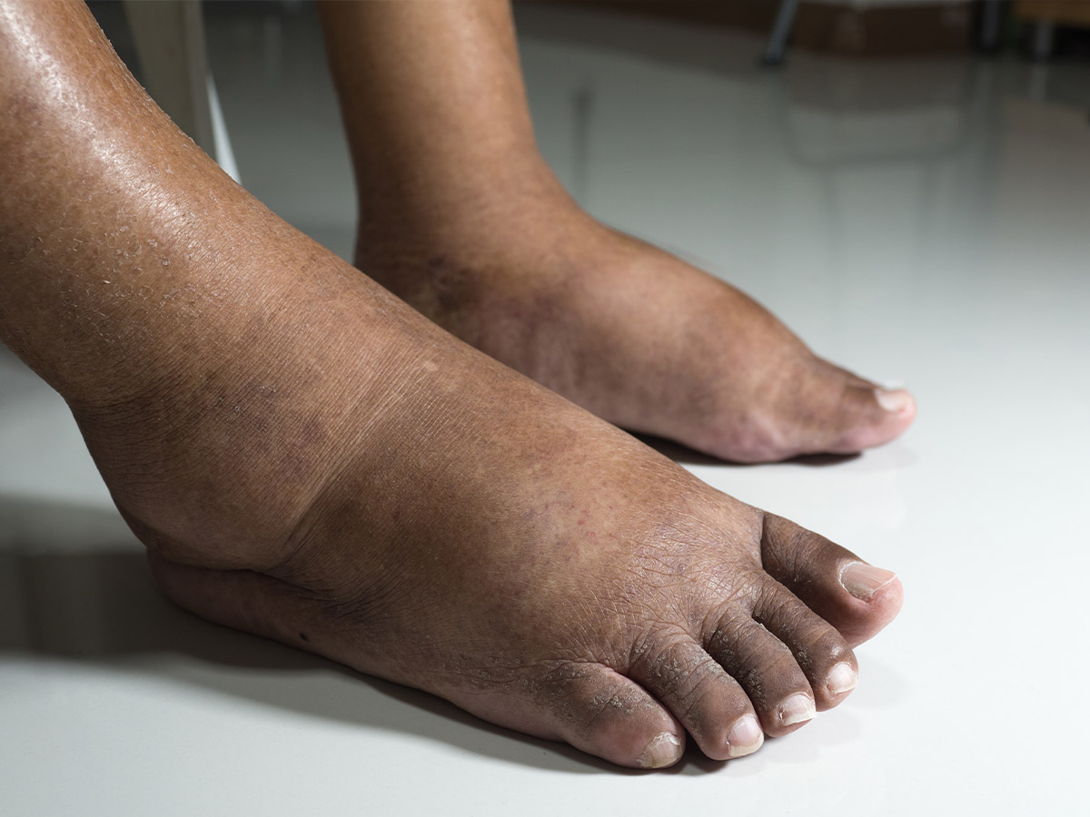 Swelling in Legs, Ankles, or Feet