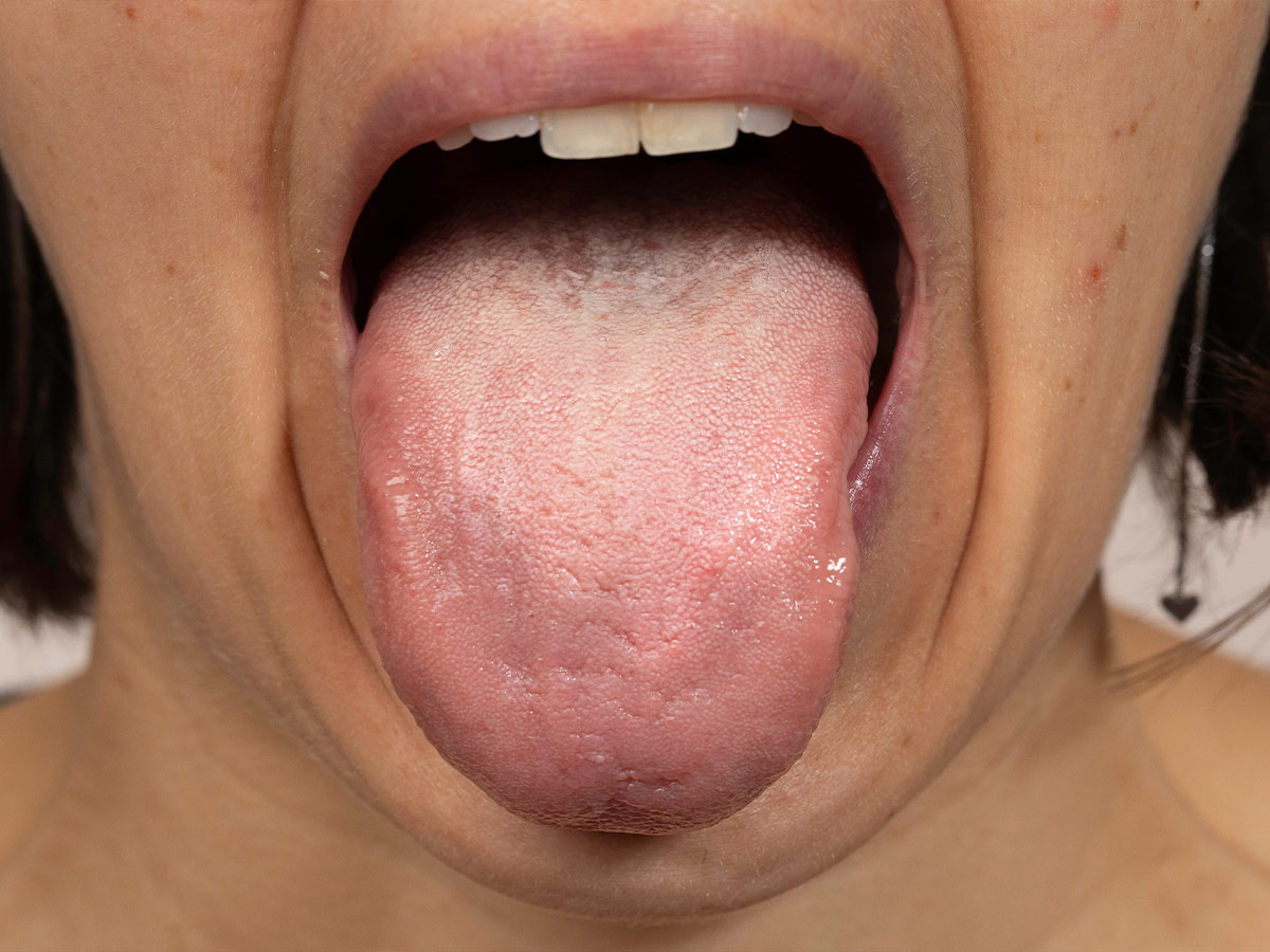 Excessive Saliva Production