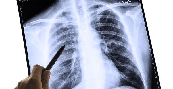 a doctor points to a suspicious mesothelioma spot in a lung x-ray