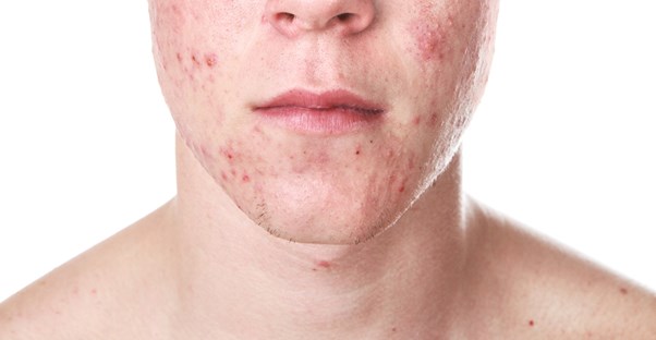 a man who needs cystic acne treatments