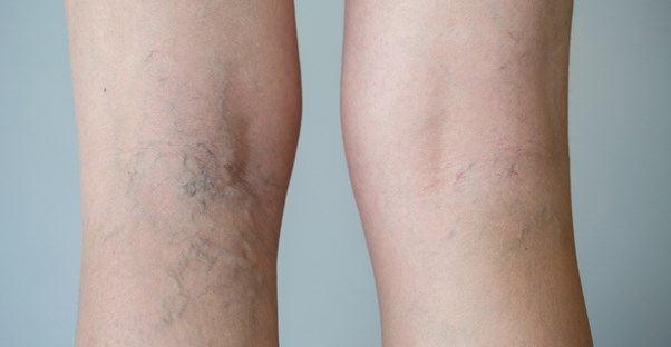 Spider veins that need treating