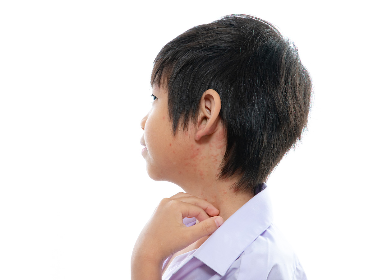 Child Chickenpox Symptoms