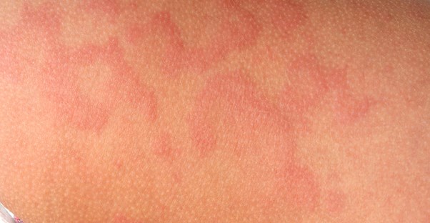 a type of urticaria