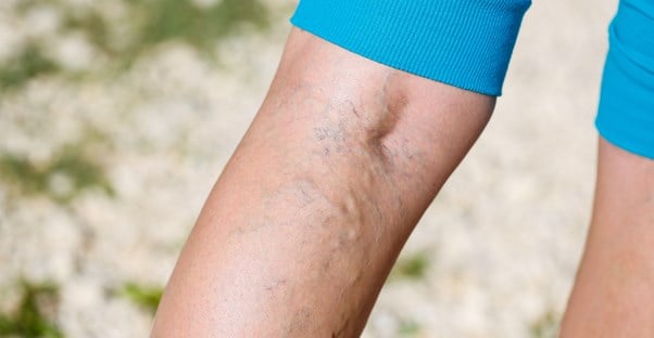 The causes of spider veins