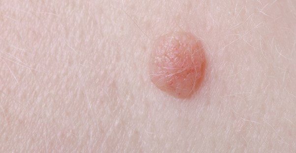 Why do warts form? 