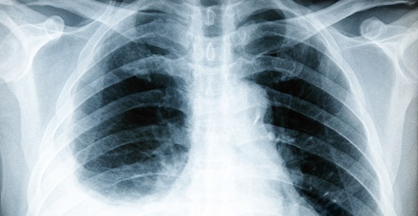 A chest x-ray