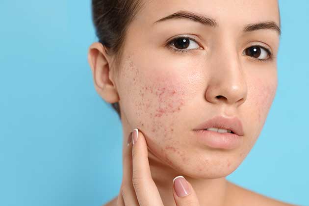 Spot Treat Acne