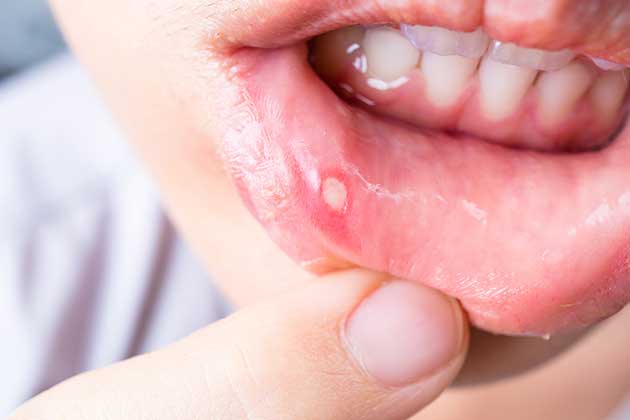 Heal a Canker Sore