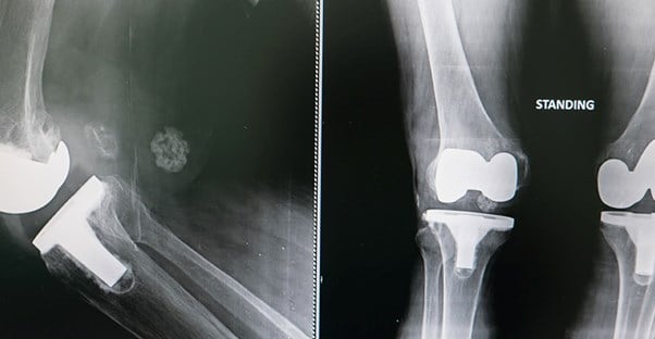 A replaced knee