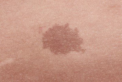 Does Your Birthmark Have a Medical Meaning?