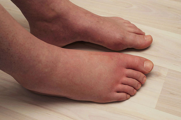 Swelling