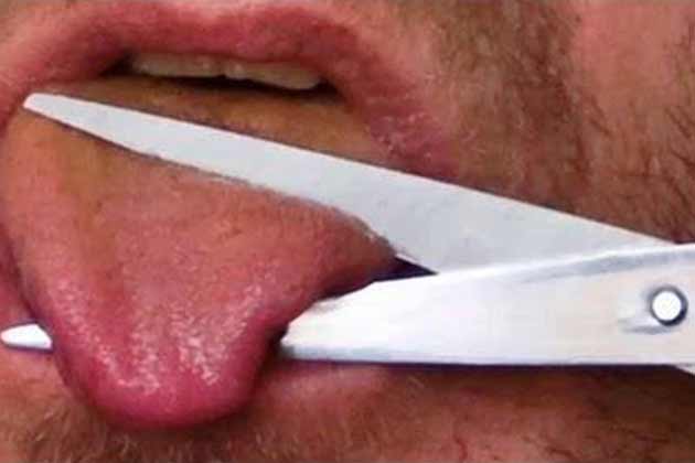 Hemiglossectomy