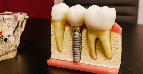 dental implants lifetime