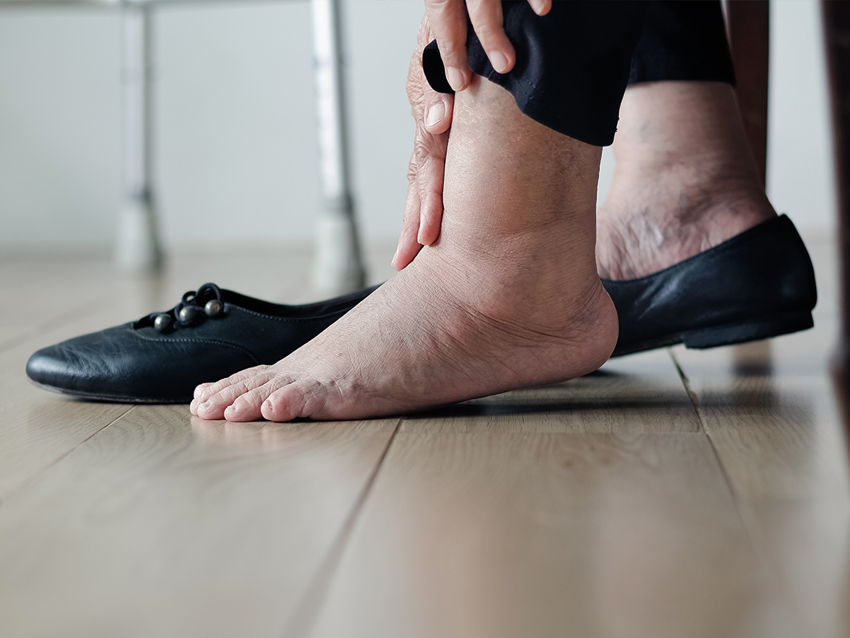 Swelling in Legs, Feet, or Ankles