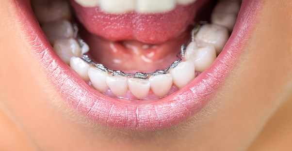 teeth illustrating how braces work