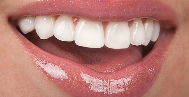 a woman who knows what dental veneers are