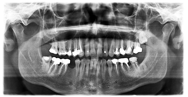 an X-ray showing that a patient needs dental veneers