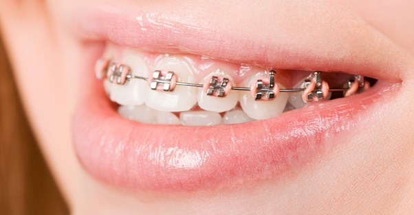 a person who knows the cost of dental braces