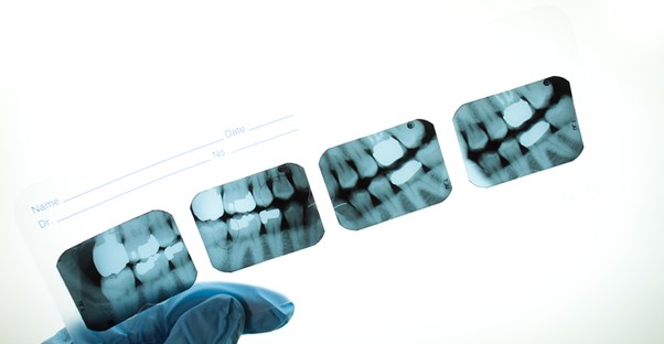 X-rays used to identify tooth decay