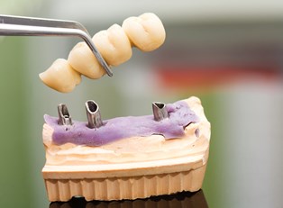 Understanding Partial Dentures