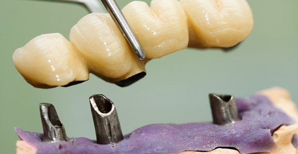 A dentist installs cosmetic dental implants