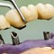 What are Cosmetic Dental Implants?