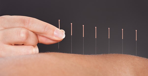 a line of acupuncture needles