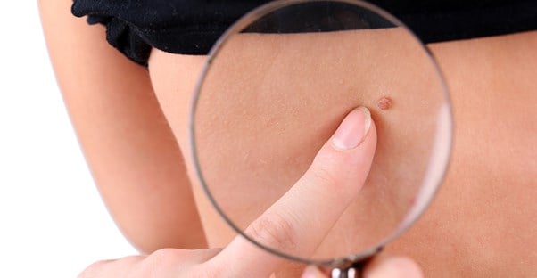 A dermatologist holds up a magnifying glass and points to a mole on the back of a patient