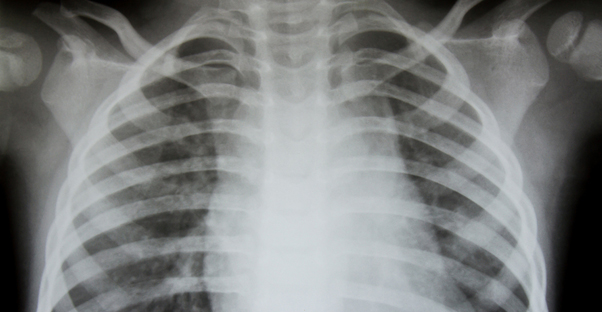 an x-ray of a lung may show the cause of COPD