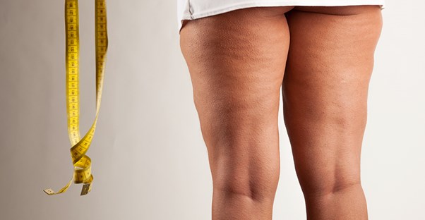 A woman worries about cellulite