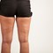 5 Reasons You Shouldn't Worry About Cellulite