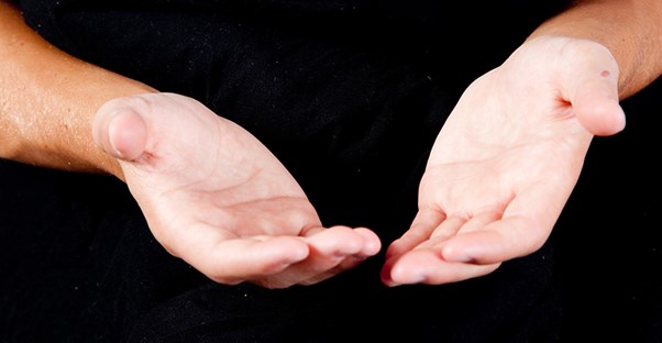 An acromegaly patient with enlarged hands